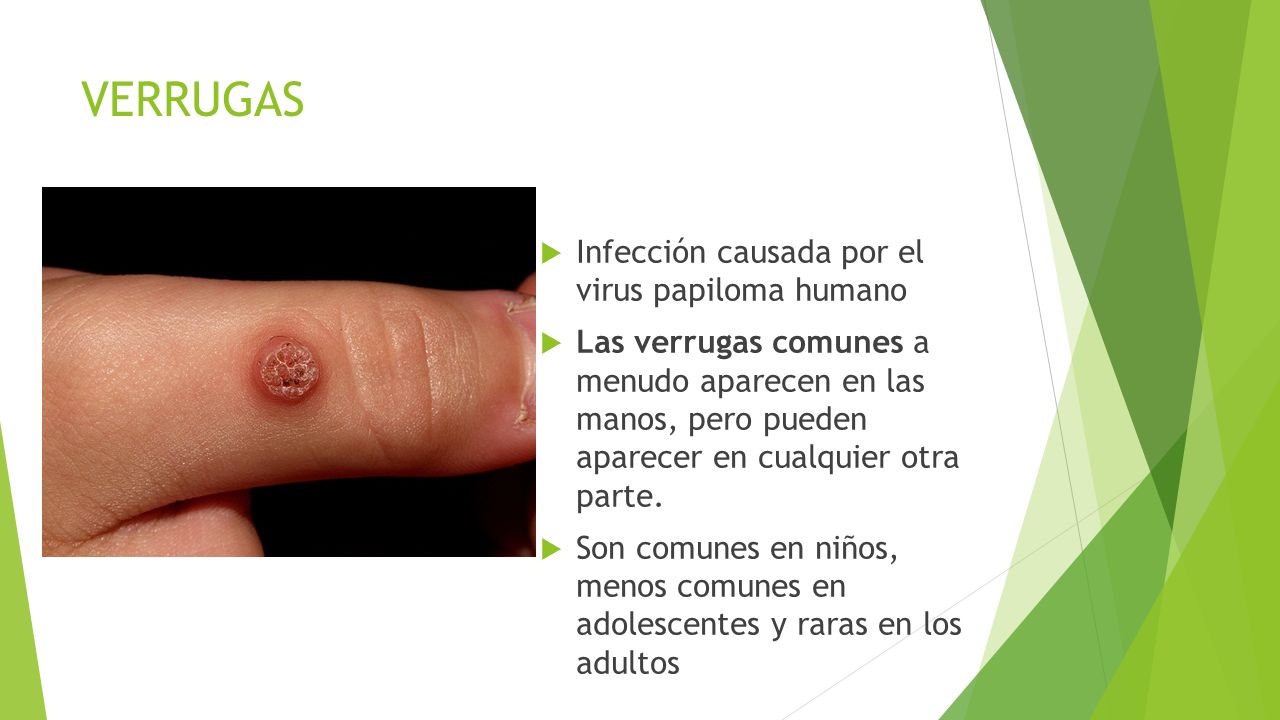 virus papiloma humano en la mano